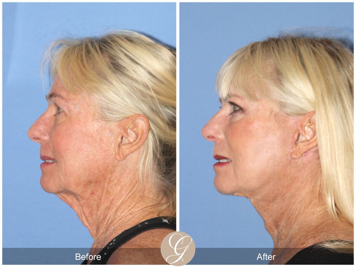 Facelift Sixties Before & After Photo