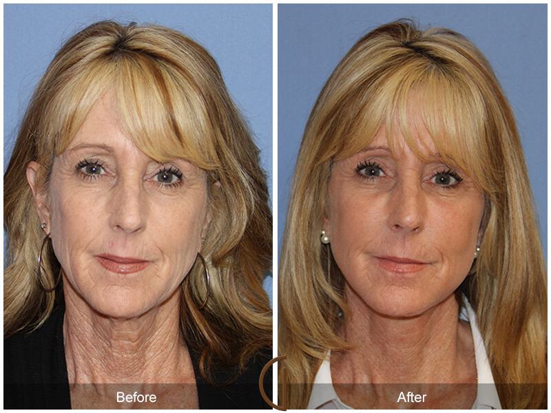 Facelift Sixties Before & After Photo