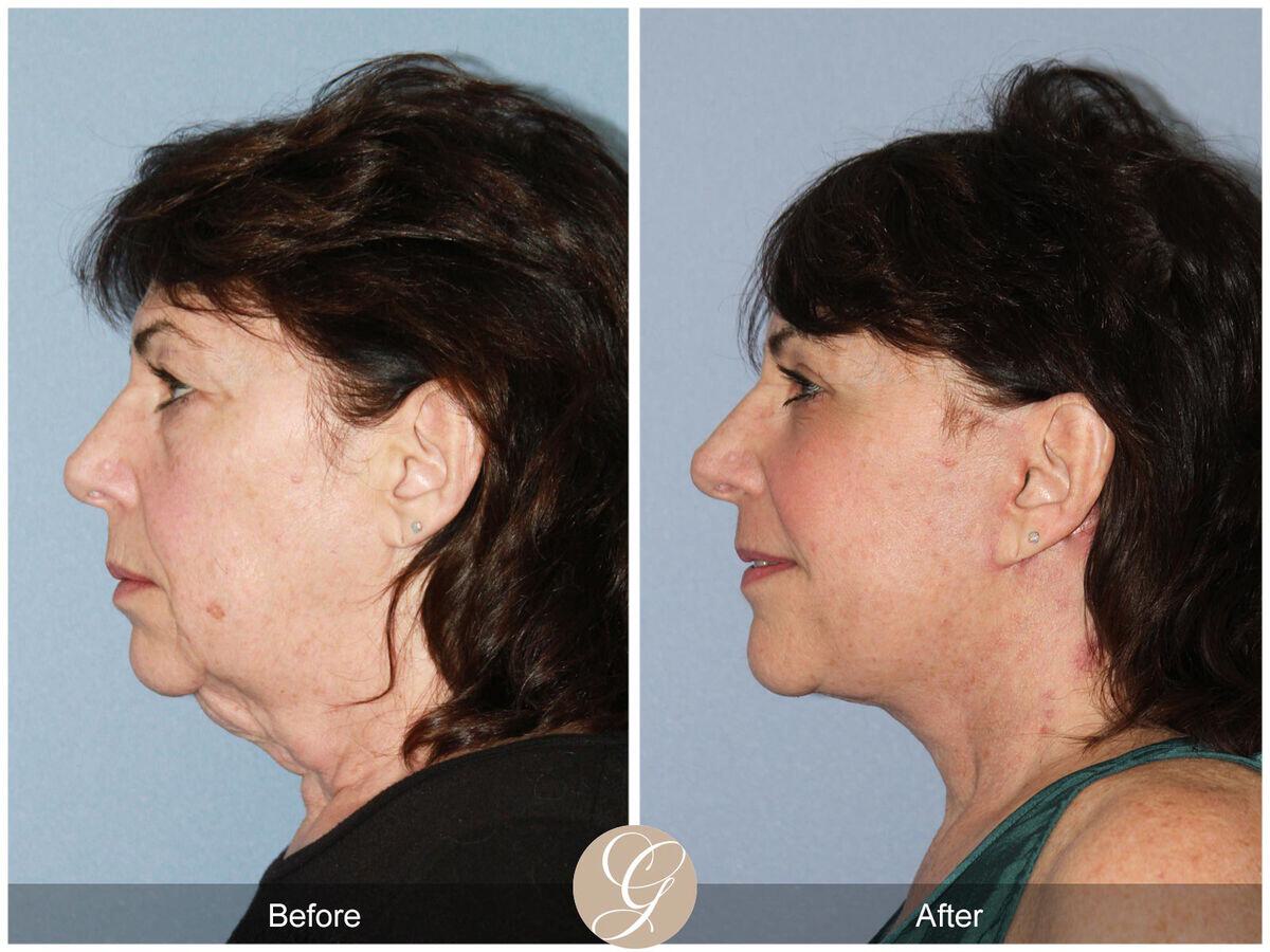 Facelift Sixties Before & After Photo