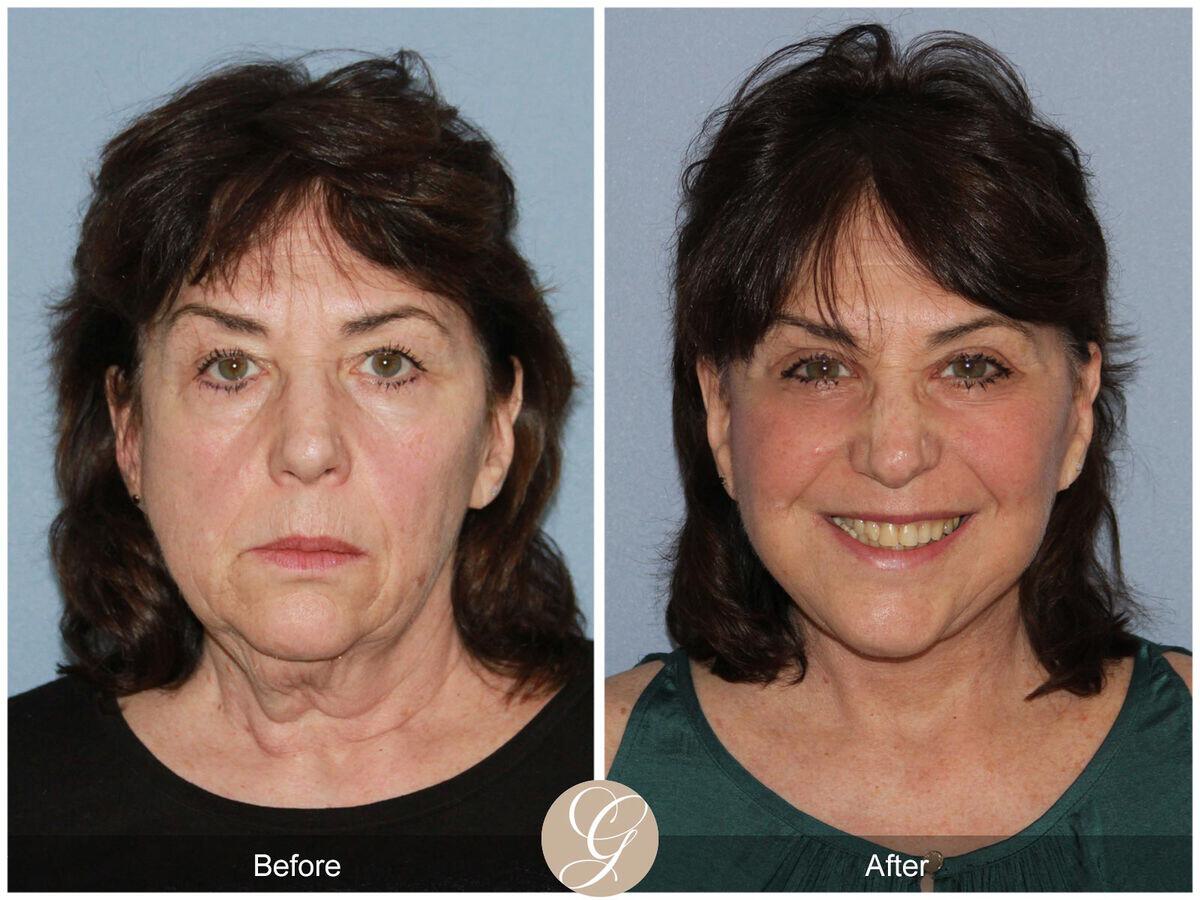 Facelift Sixties Before & After Photo