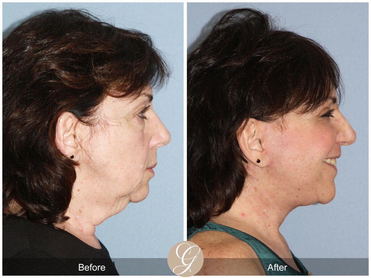 Facelift Sixties Before & After Photo