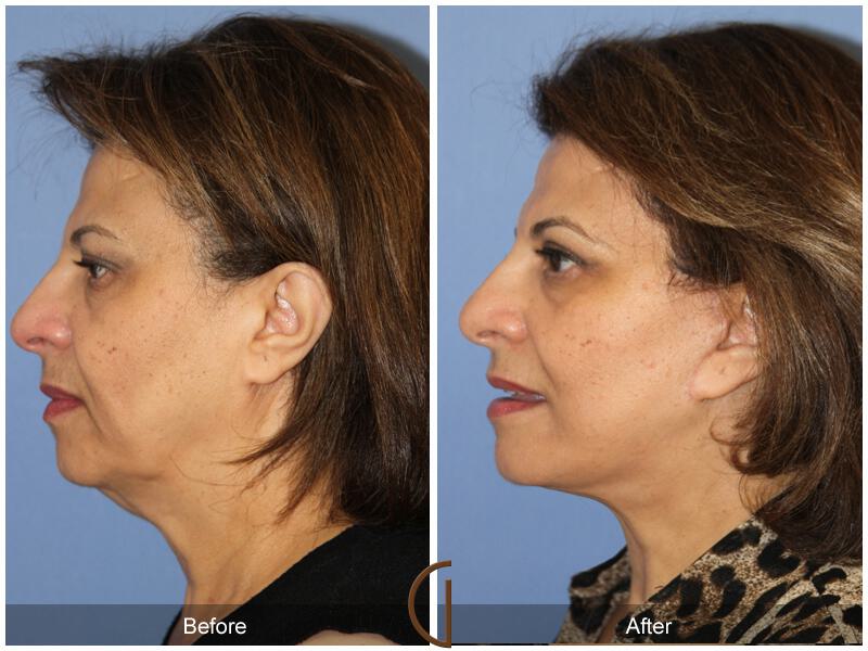 Facelift Sixties Before & After Photo