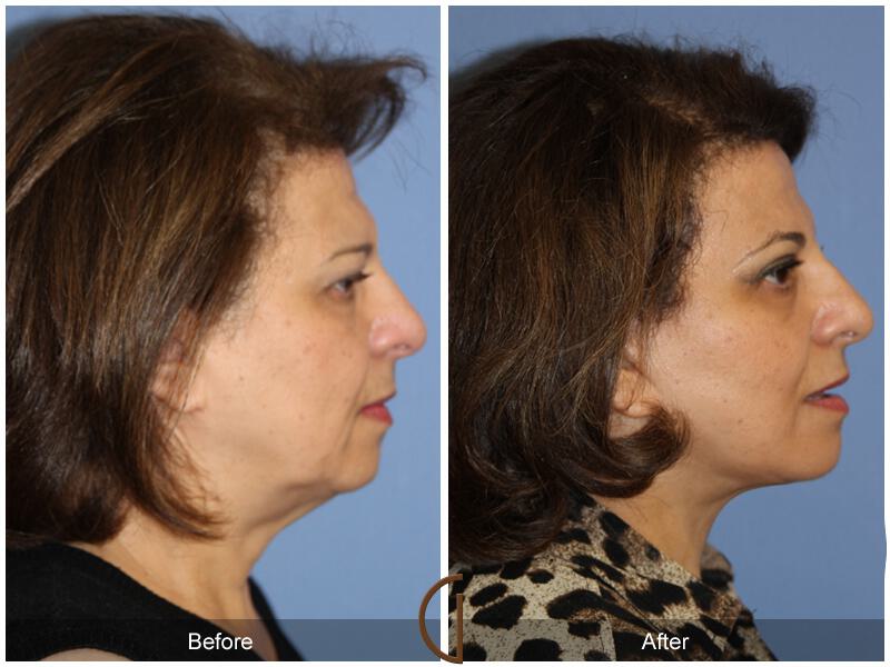 Facelift Sixties Before & After Photo