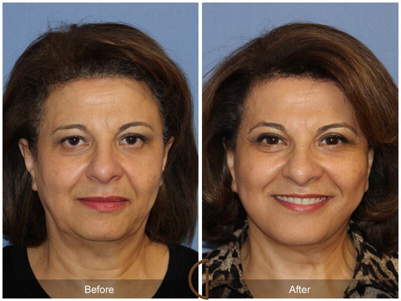 Facelift Sixties Before & After Photo