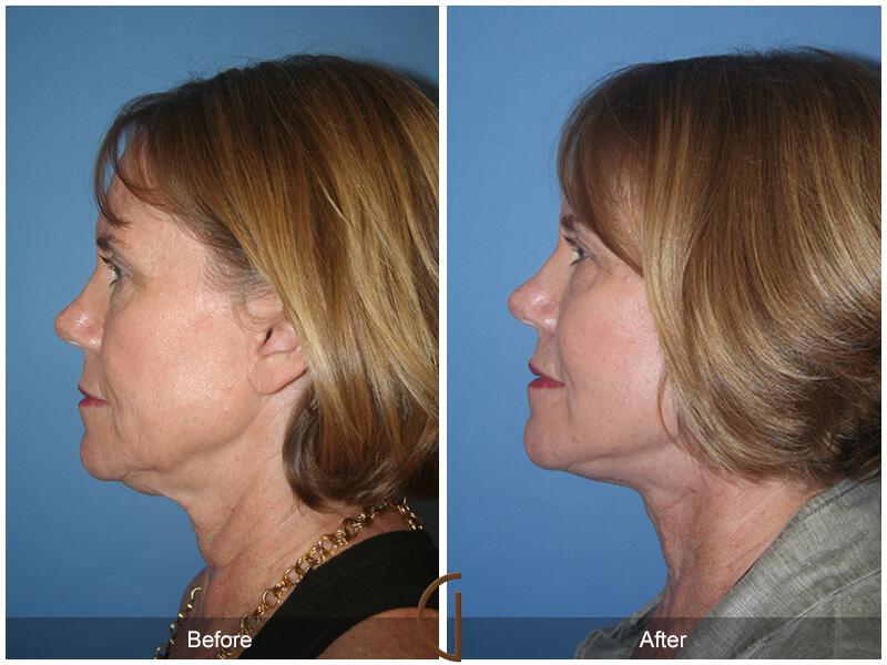 Facelift Sixties Before & After Photo