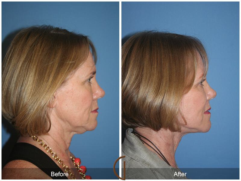 Facelift Sixties Before & After Photo