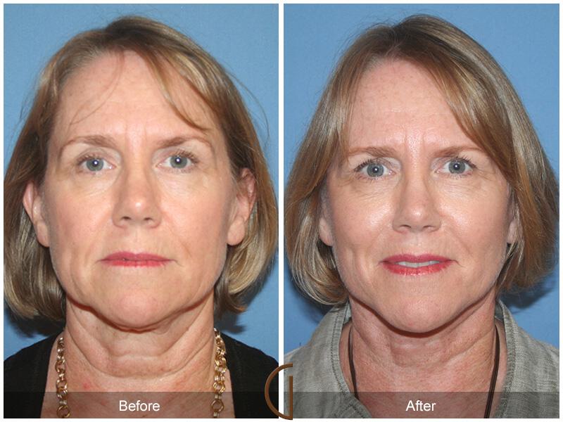 Facelift Sixties Before & After Photo