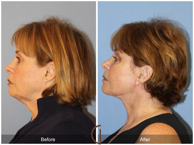 Facelift Sixties Before & After Photo