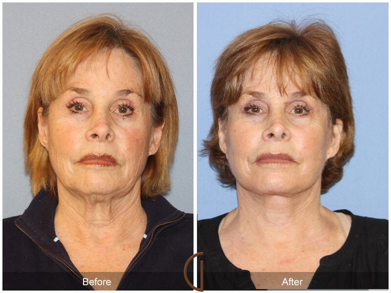 Facelift Sixties Before & After Photo