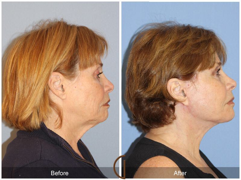 Facelift Sixties Before & After Photo