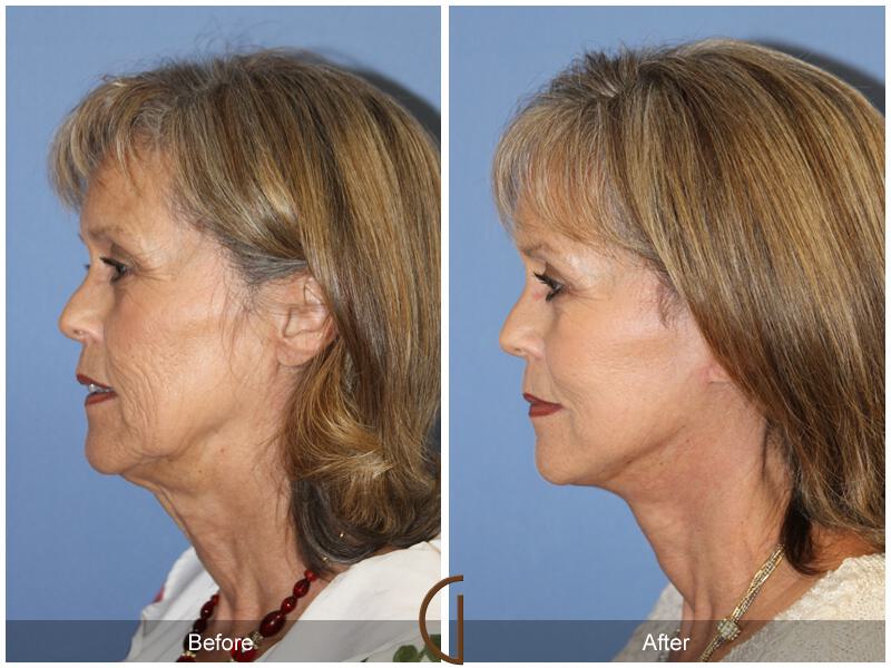 Facelift Sixties Before & After Photo