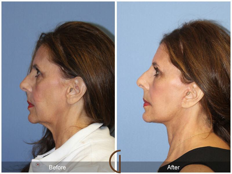 Facelift Sixties Before & After Photo