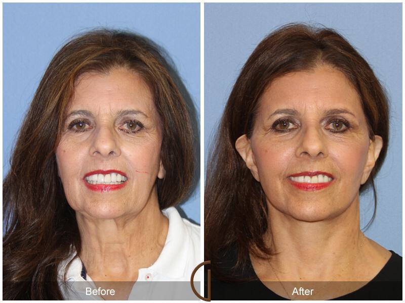 Facelift Sixties Before & After Photo