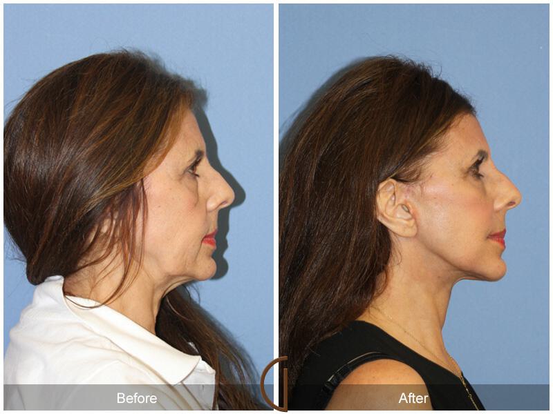 Facelift Sixties Before & After Photo