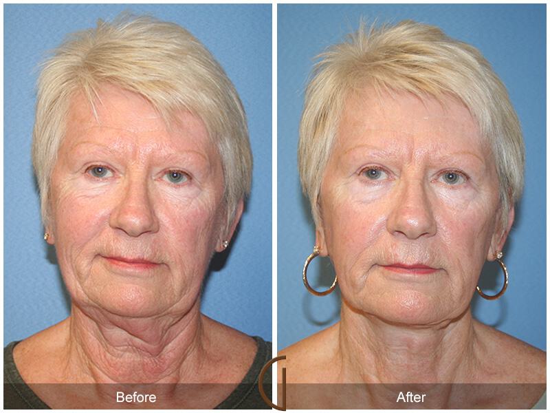 Facelift Sixties Before & After Photo