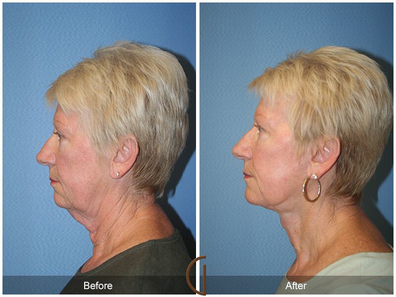 Facelift Sixties Before & After Photo