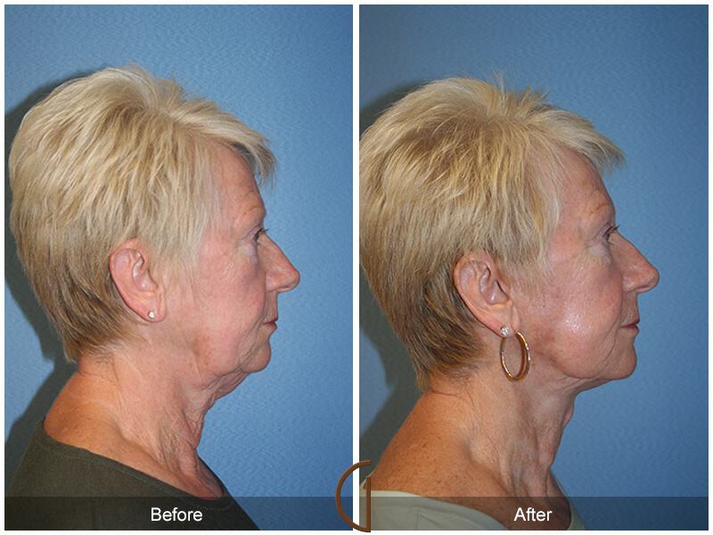 Facelift Sixties Before & After Photo