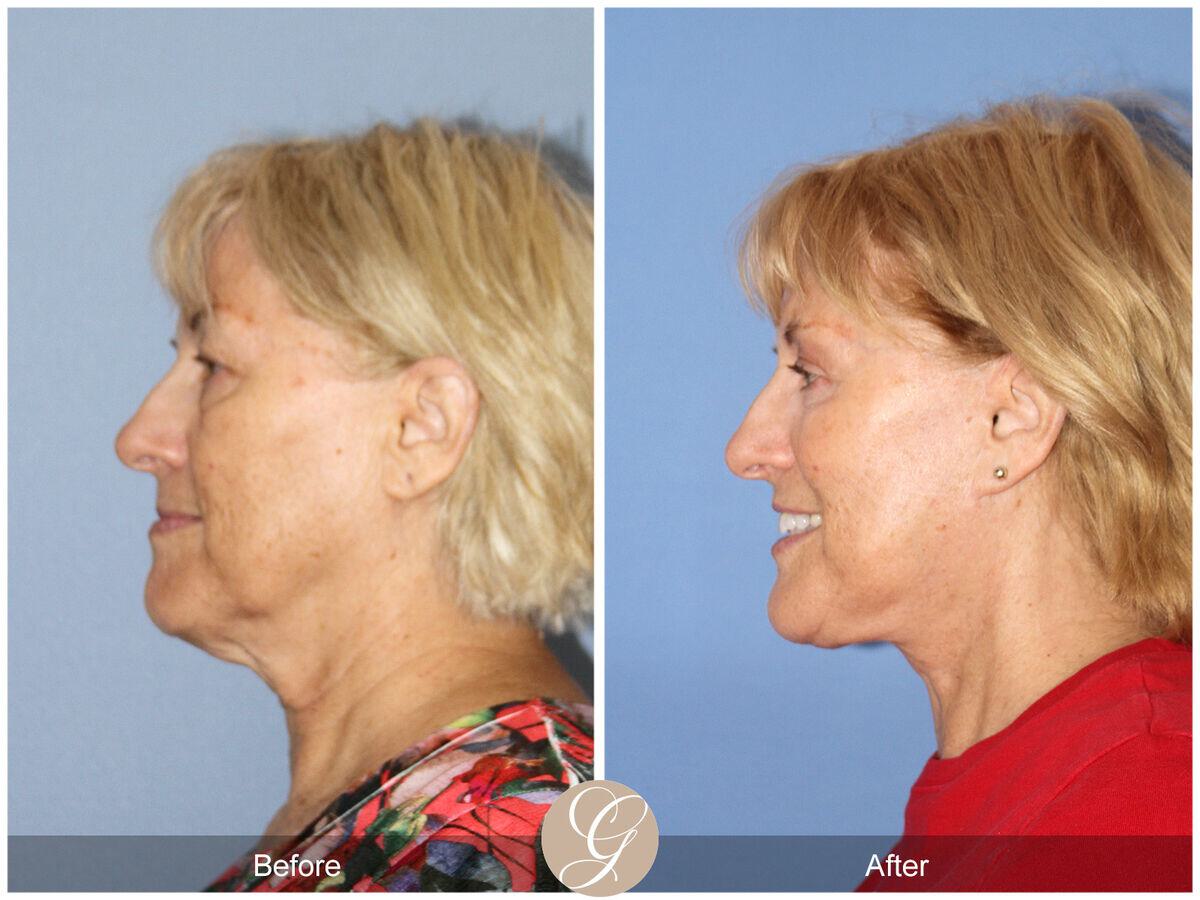 Facelift Sixties Before & After Photo