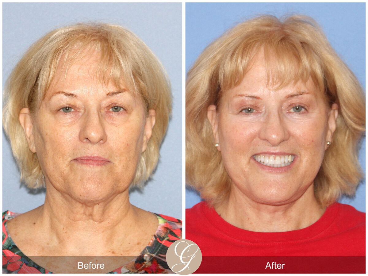 Facelift Sixties Before & After Photo