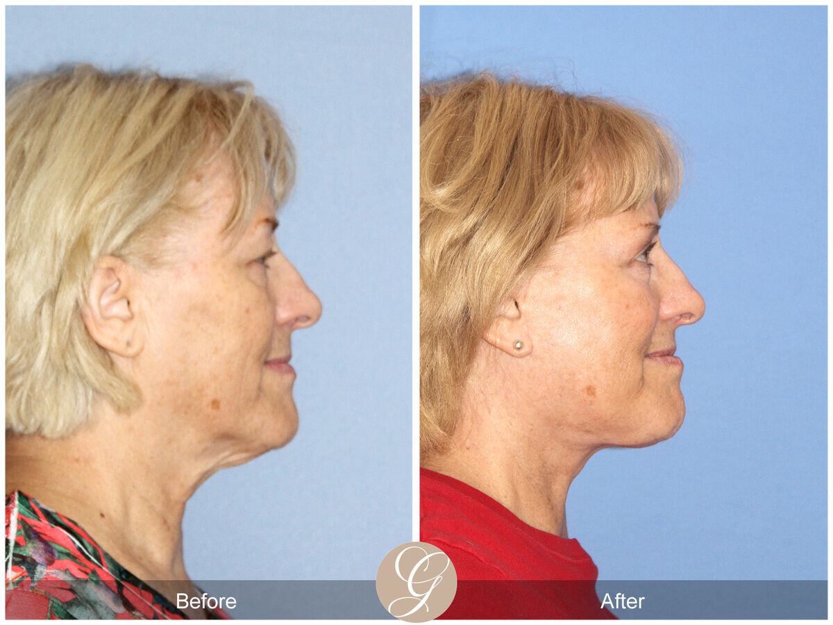 Facelift Sixties Before & After Photo