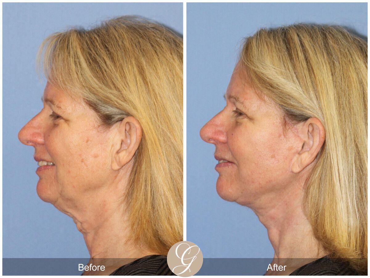 Facelift Sixties Before & After Photo