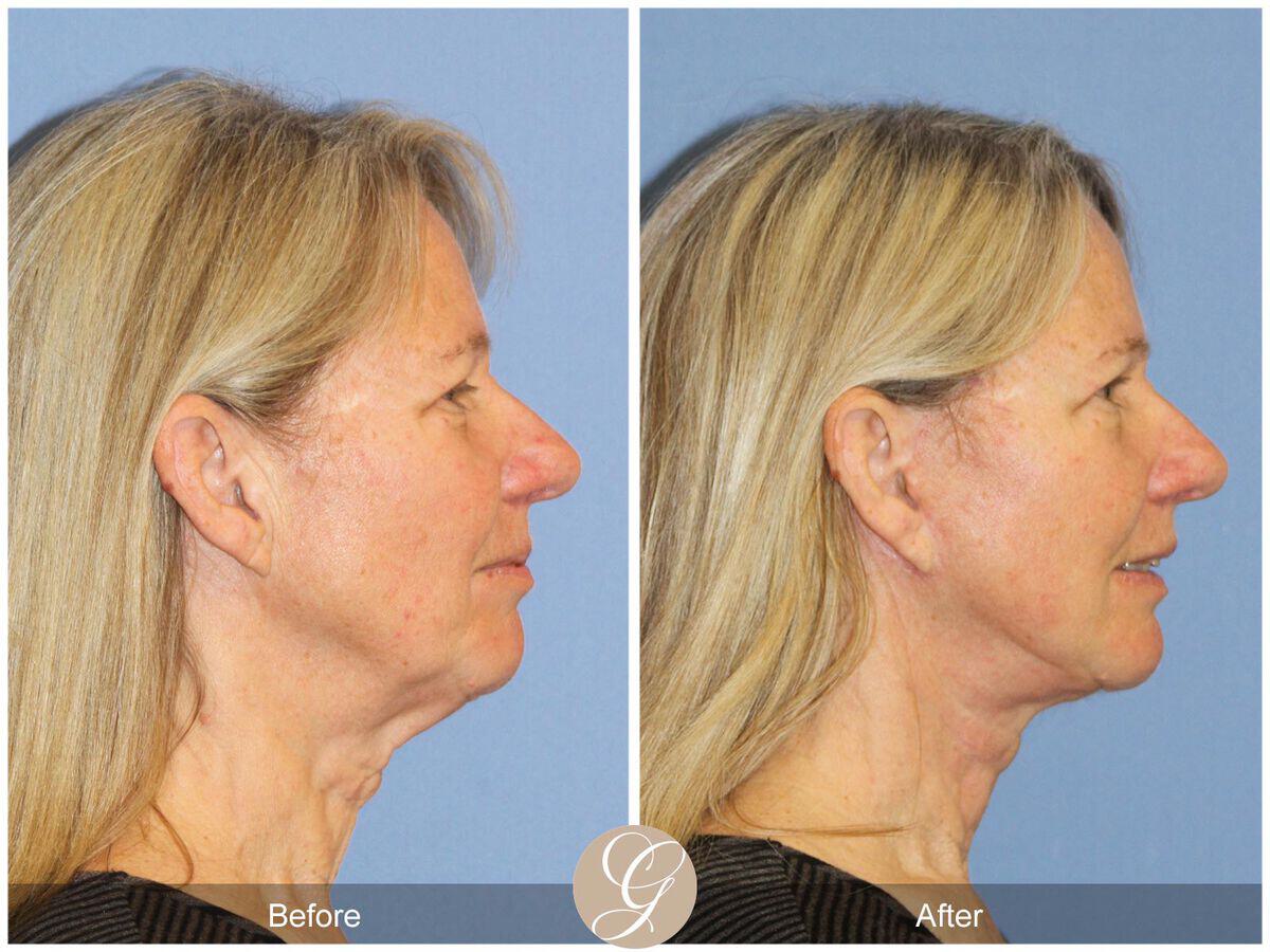 Facelift Sixties Before & After Photo