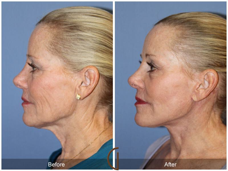 Facelift Sixties Before & After Photo