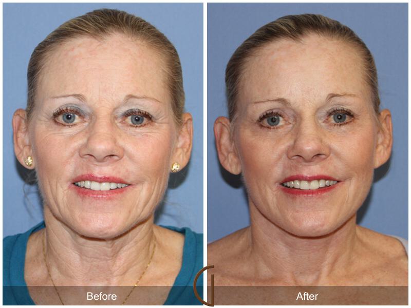 Facelift Sixties Before & After Photo