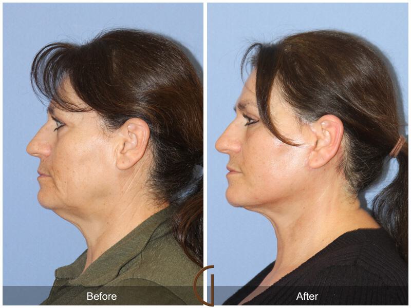 Facelift Sixties Before & After Photo