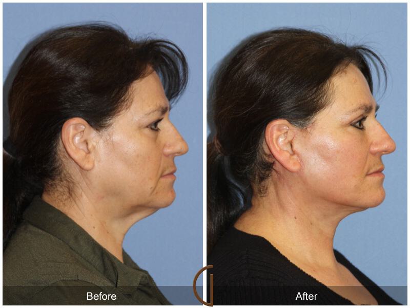 Facelift Sixties Before & After Photo