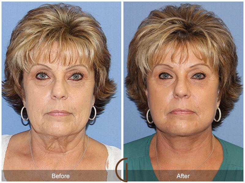 Facelift Sixties Before & After Photo