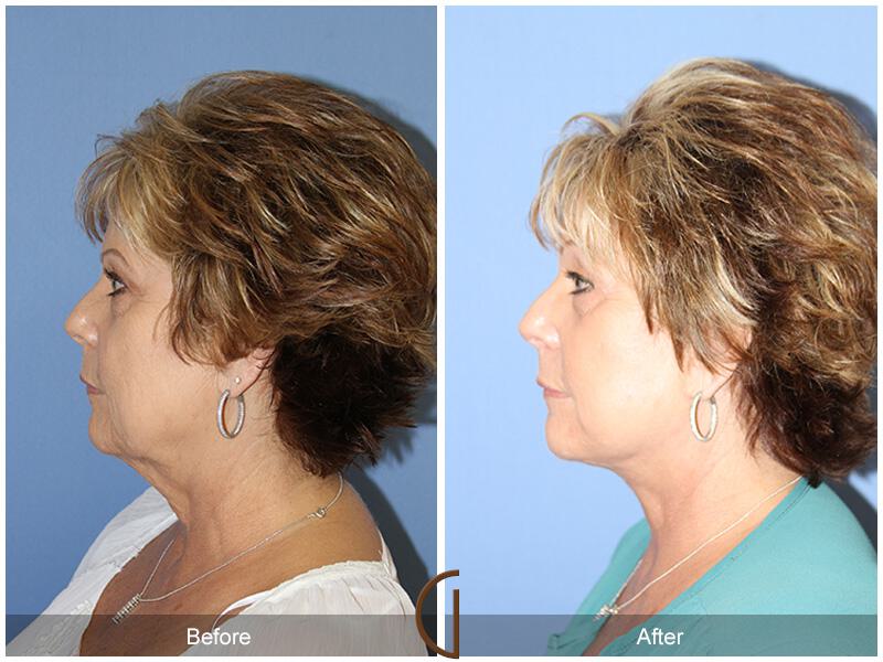 Facelift Sixties Before & After Photo