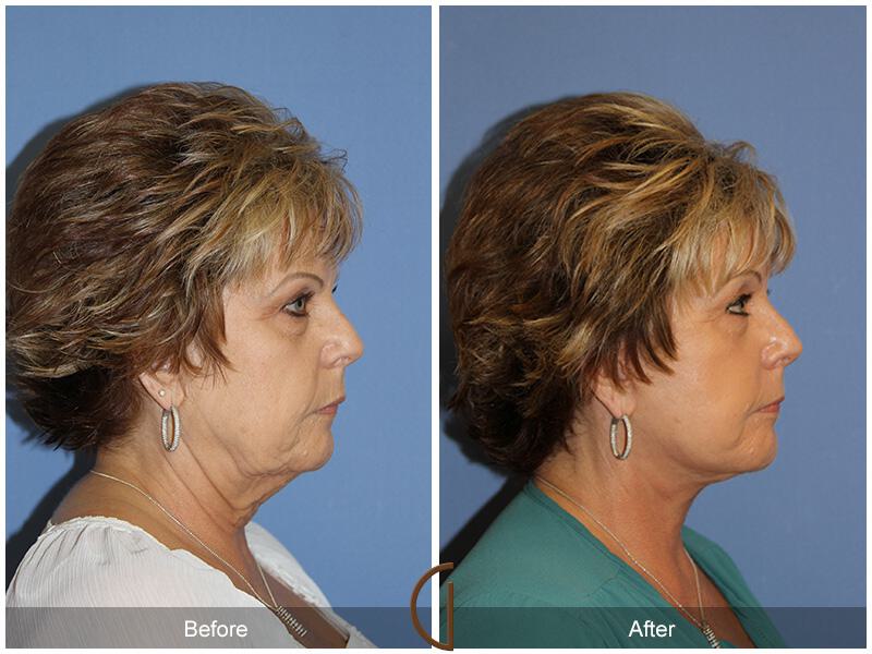 Facelift Sixties Before & After Photo