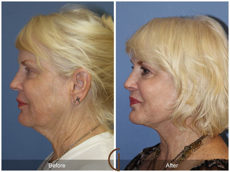 Facelift Sixties Before & After Photo