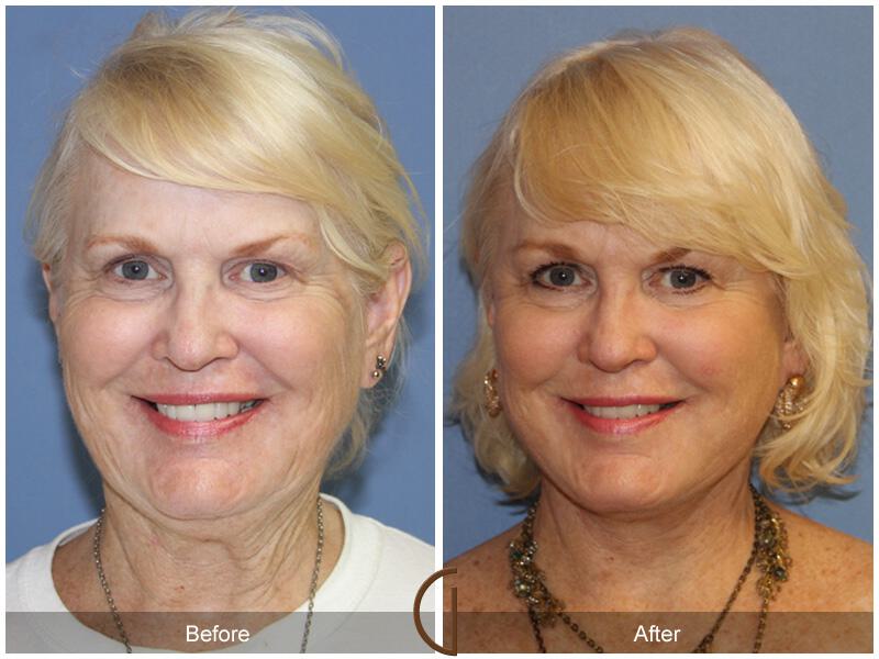 Facelift Sixties Before & After Photo