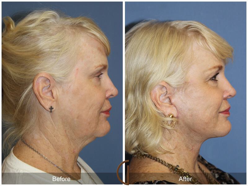 Facelift Sixties Before & After Photo