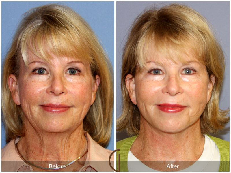 Facelift Sixties Before & After Photo