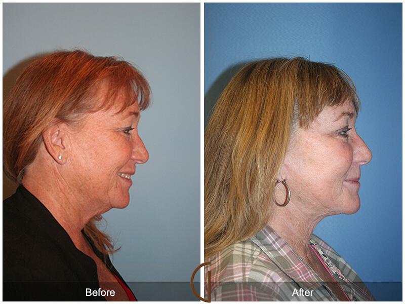 Facelift Sixties Before & After Photo