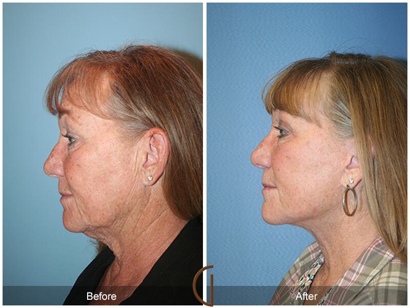 Facelift Sixties Before & After Photo