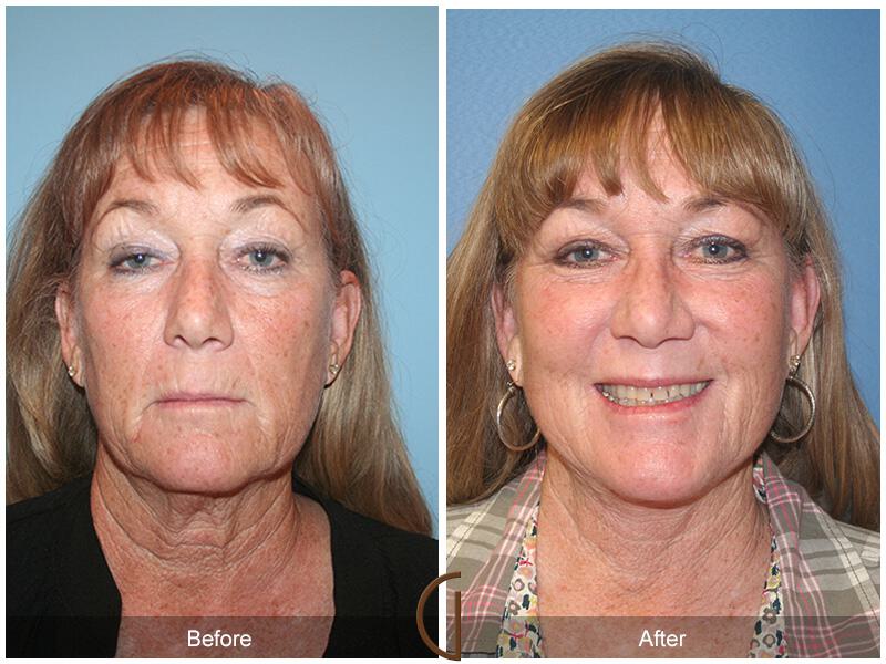 Facelift Sixties Before & After Photo