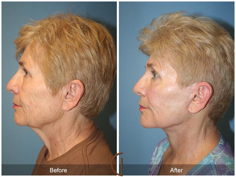 Facelift Sixties Before & After Photo