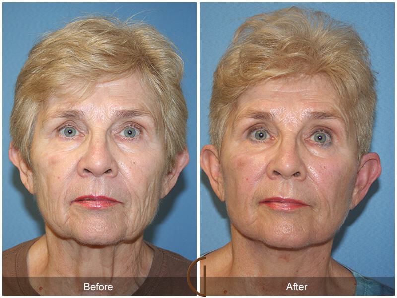 Facelift Sixties Before & After Photo