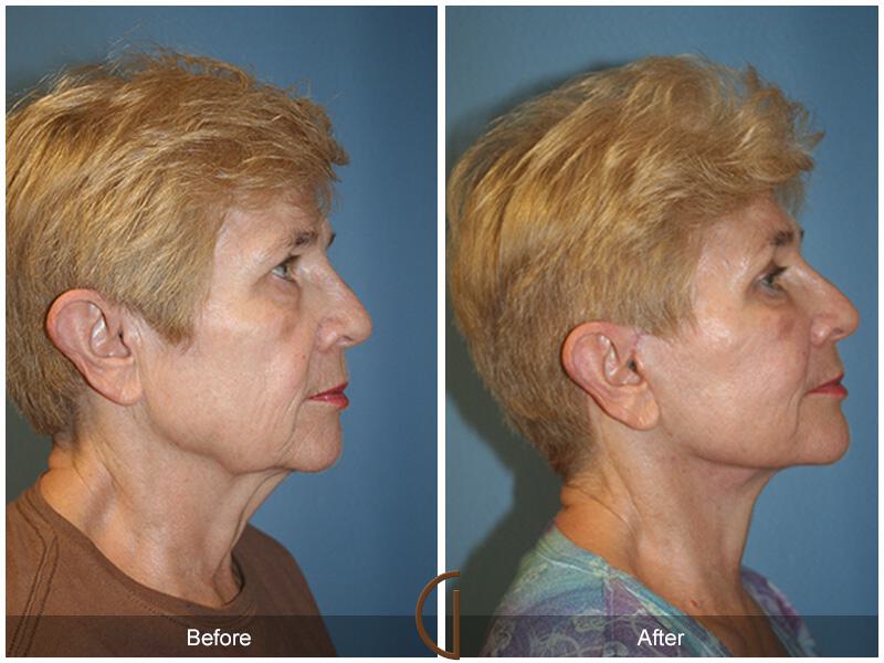 Facelift Sixties Before & After Photo