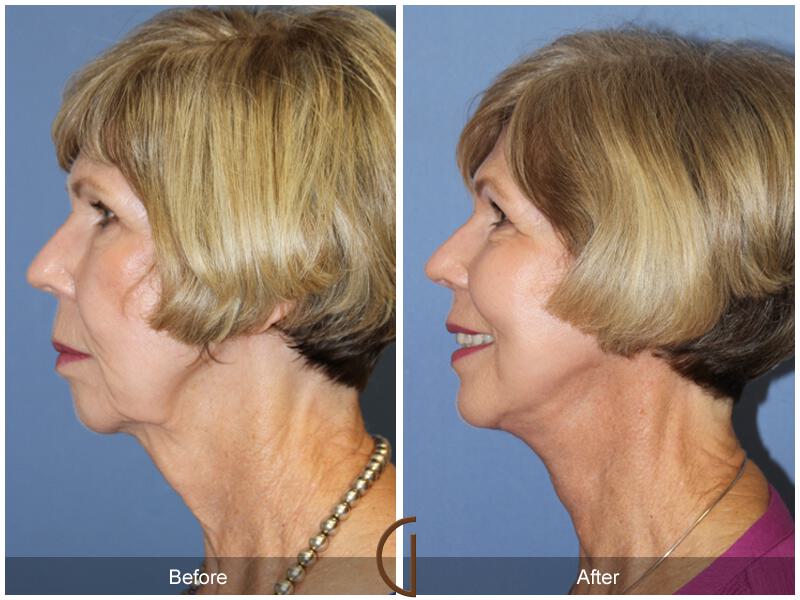 Facelift Sixties Before & After Photo