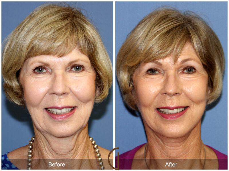 Facelift Sixties Before & After Photo