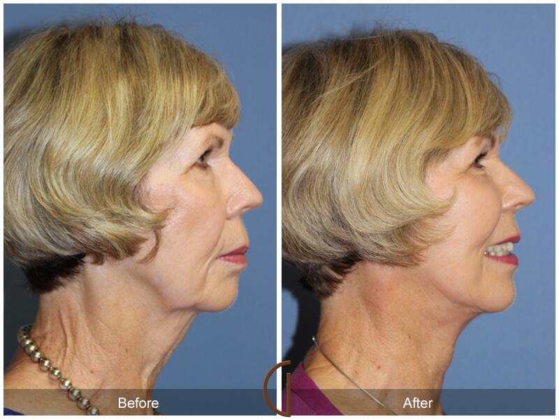 Facelift Sixties Before & After Photo