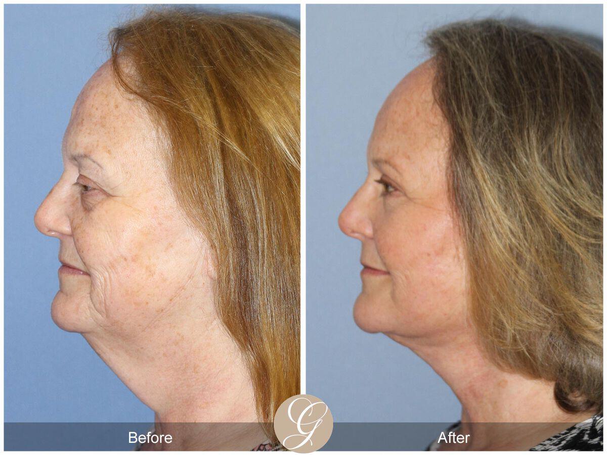 Facelift Sixties Before & After Photo