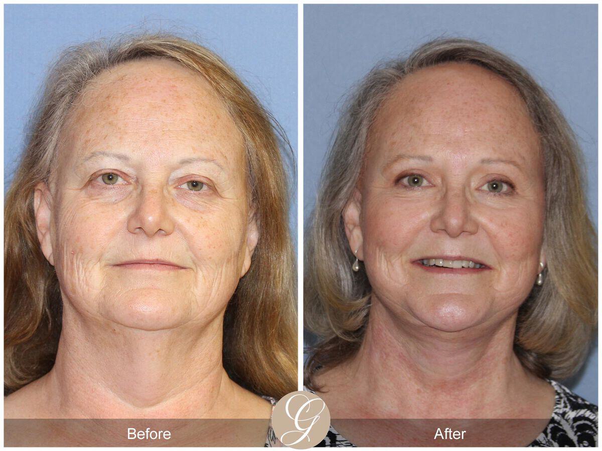 Facelift Sixties Before & After Photo