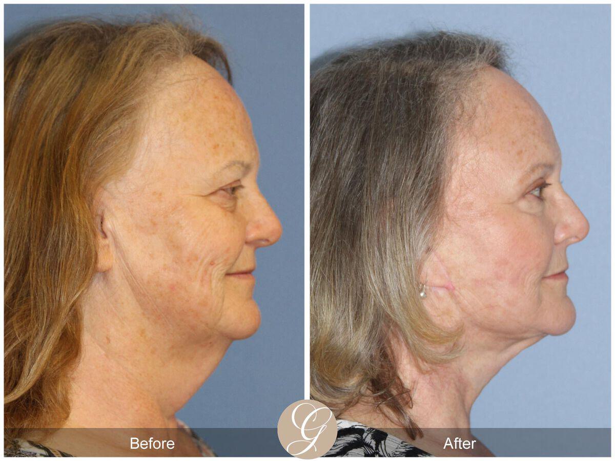 Facelift Sixties Before & After Photo