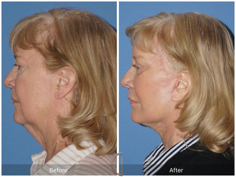 Facelift Sixties Before & After Photo